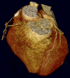 ¿Qué es la Cardiopatía isquémica? Prevención y diagnóstico mediante TAC coronario o coronariografía no invasiva